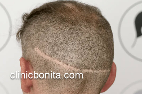 کاشت مو با بهترین روش در اصفهان | کلینیک بنیتای اصفهان