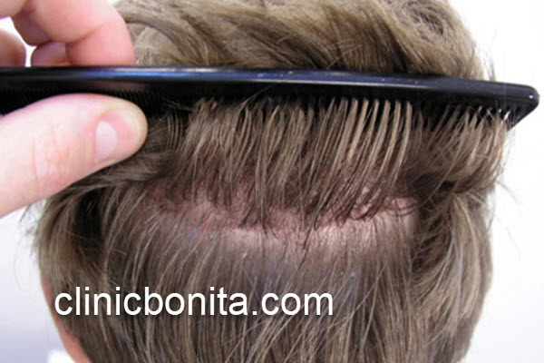 ارائه خدمات کاشت مو برای پشت سر در اصفهان | کلینیک بنیتای اصفهان