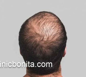 کاشت موی پشت سر در کلینیک اصفهان | کلینیک بنیتای اصفهان