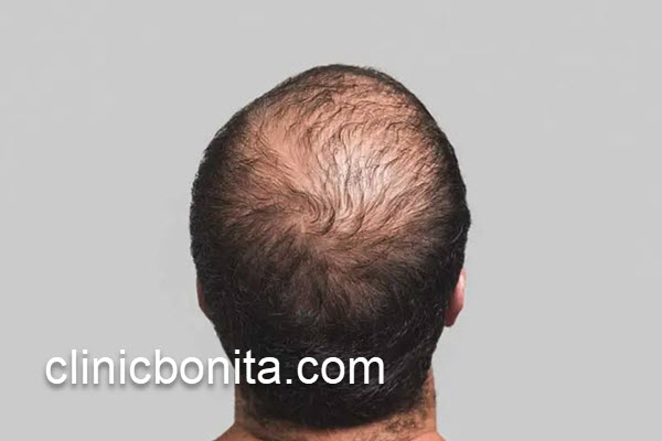 کاشت موی پشت سر در کلینیک اصفهان | کلینیک بنیتای اصفهان