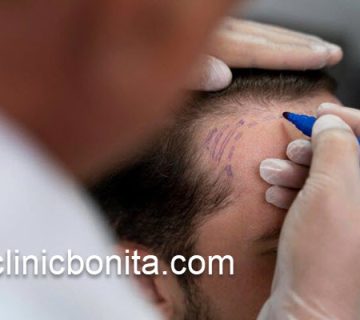 پیوند مو با بهترین تجهیزات در اصفهان | کلینیک بنیتای اصفهان