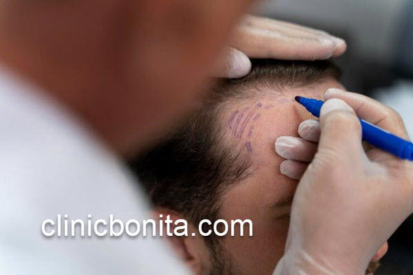 پیوند مو با بهترین تجهیزات در اصفهان | کلینیک بنیتای اصفهان