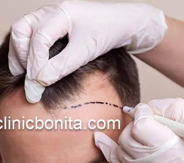 قیمت کاشت مو در اصفهان | کلینیک بنیتای اصفهان