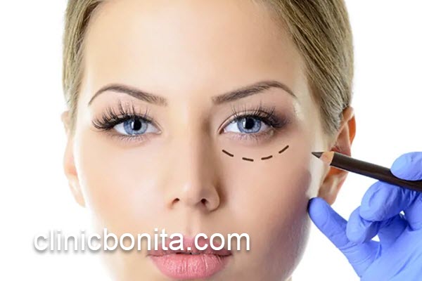 جراحی بلفاروپلاستی و اقدامات پس از آن | کلینیک بنیتای اصفهان