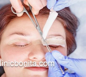 هزینه عمل بلفاروپلاستی پلک بالا | کلینیک بنیتای اصفهان