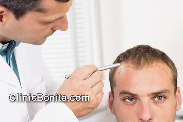 حداکثر میزان تراکم کاشت موی طبیعی | کلینیک بنیتای اصفهان