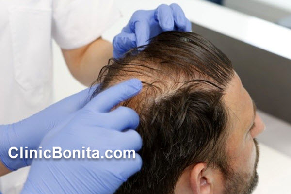 عوامل مؤثر بر کاشت مو با تراکم بالا | کلینیک بنیتای اصفهان