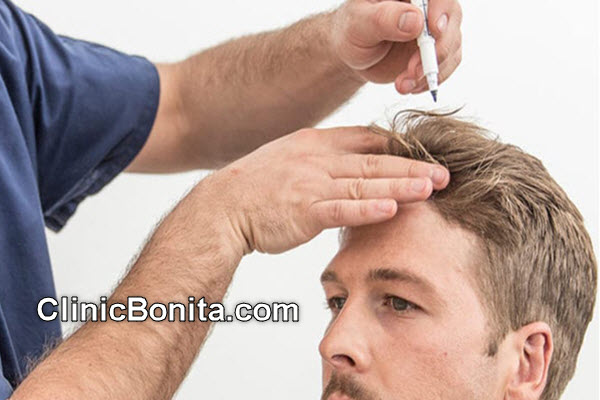 قیمت کاشت مو به روش ترکیبی چقدر است؟ | کلینیک بنیتای اصفهان