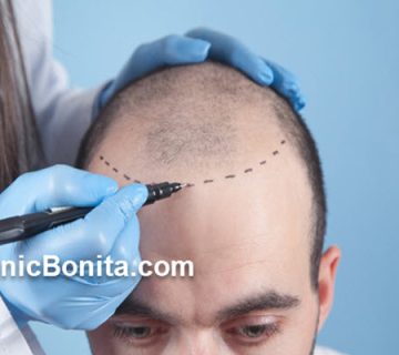 کاشت موی طبیعی با تراکم بالا | کلینیک بنیتای اصفهان