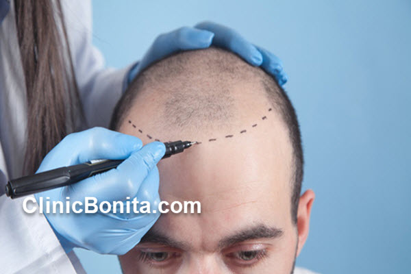 کاشت موی طبیعی با تراکم بالا | کلینیک بنیتای اصفهان