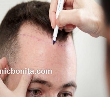 چه کسانی نمی توانند کاشت مو را انجام دهند؟ | کلینیک بنیتای اصفهان