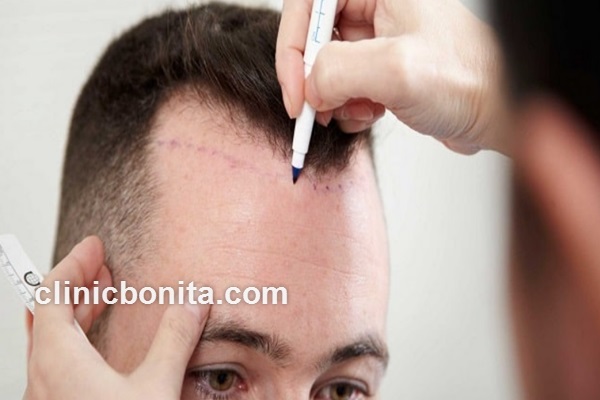 چه کسانی نمی توانند کاشت مو را انجام دهند؟ | کلینیک بنیتای اصفهان