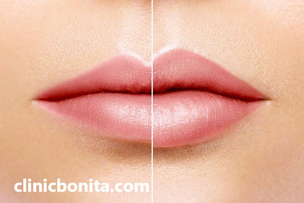 جراحی لیفت سانترال لب | کلینیک بنیتای اصفهان