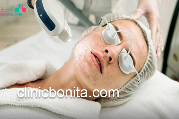رفع لک های صورت با لیزر کیوسوئیچ | کلینیک بنیتای اصفهان