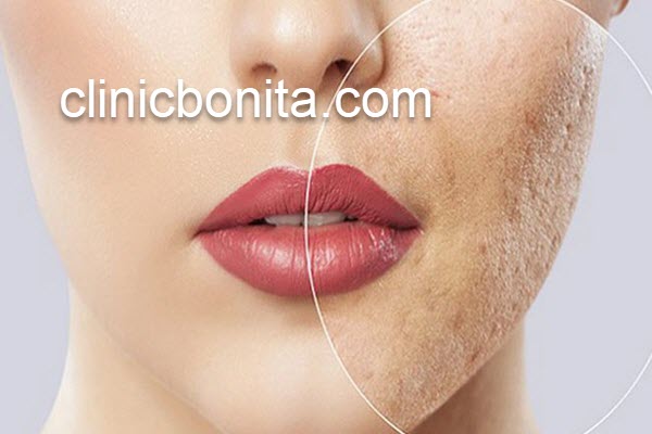 بهبود لک های صورت با لیزر کیوسوئیچ در اصفهان |کلینیک بنیتای اصفهان