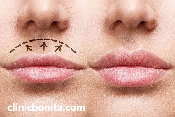 لیفت سانترال لب | کلینیک بنیتای اصفهان