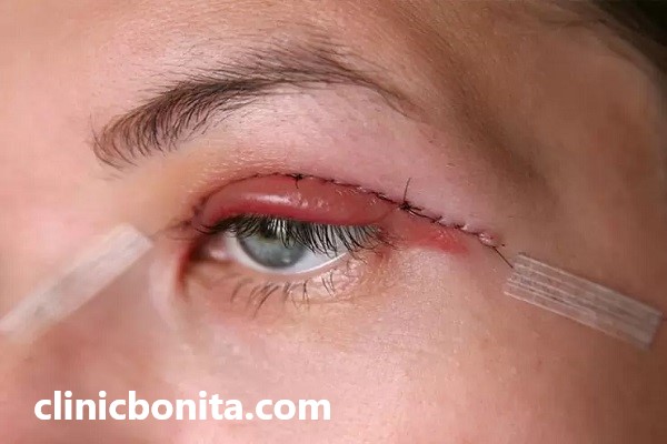 عمل بلفاروپلاستی در اصفهان | کلینیک بنیتای اصفهان