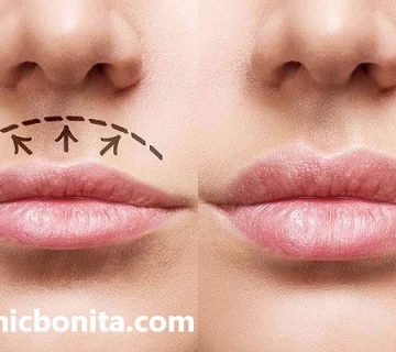 جرحی لیفت سانترال لب در اصفهان | کلینیک بنیتای اصفهان