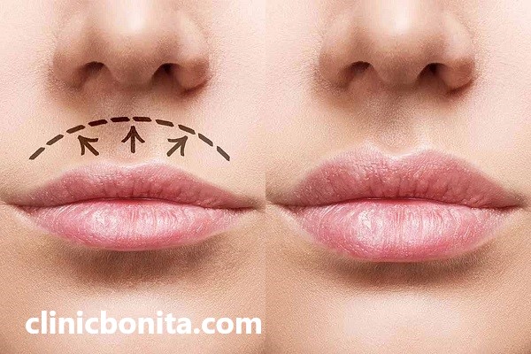 جرحی لیفت سانترال لب در اصفهان | کلینیک بنیتای اصفهان