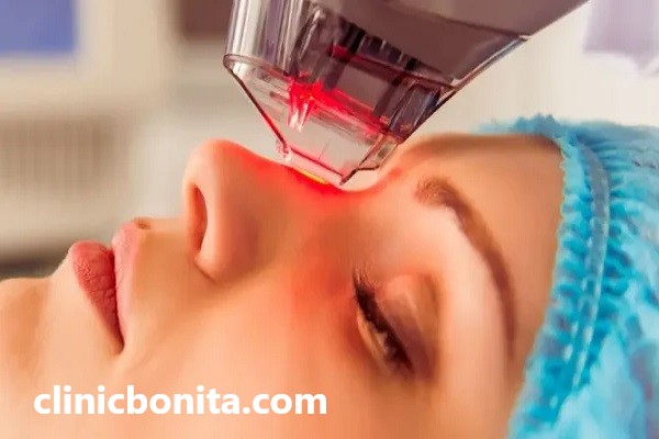 درمان پوست با فرکشنال رادیوفرکانس در اصفهان | کلینیک بنیتای اصفهان