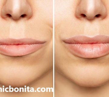 لیفت سانترال لب توسط بهترین کلینیک در اصفهان | کلینیک بنیتای اصفهان