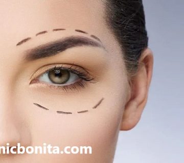 نحوه انجام عمل بلفاروپلاستی در اصفهان | کلینیک بنیتای اصفهان