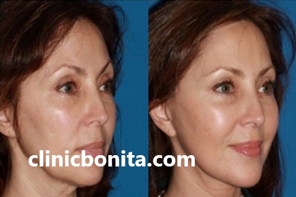 کاندیدای مناسب تزریق چربی | کلینیک بنیتای اصفهان