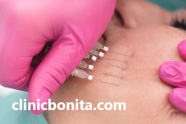 نحوه انجام لیفت صورت با نخ در بهترین کلینیک اصفهان | کلینیک بنیتا