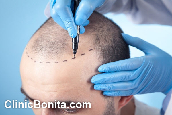 ویژگیهای بهترین متخصص کاشت مو در اصفهان | کلینیک بنیتا