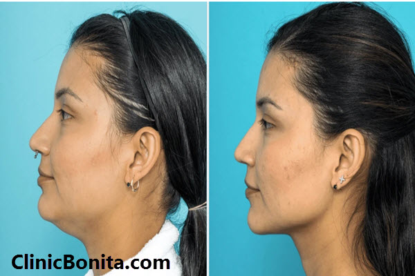 مزیت های انجام لیپوساکشن غبغب