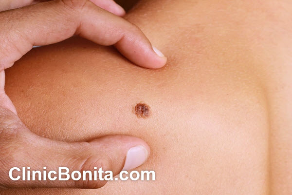 انواع روش های خالبرداری | کلینیک بنیتای اصفهان