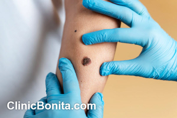 مزایای برداشتن خال و زگیل با لیزر | کلینیک بنیتای اصفهان