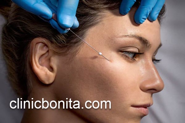 هزینه لیفت شقیقه با نخ در اصفهان چقدر می باشد؟ | کلینیک بنیتا اصفهان