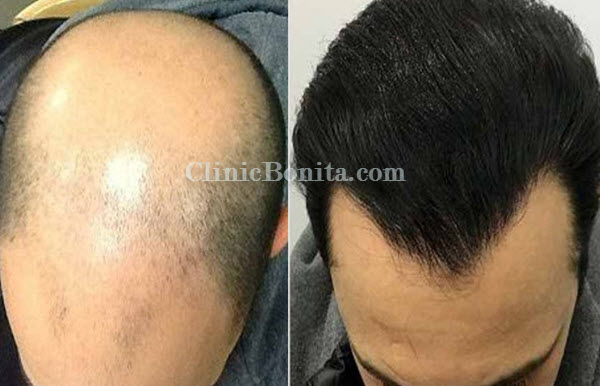 کاشت مو به روش تکثیر کلینیک بنیتا اصفهان