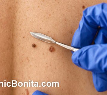 هزینه برداشتن خال و زگیل در اصفهان | کلینیک بنیتای اصفهان