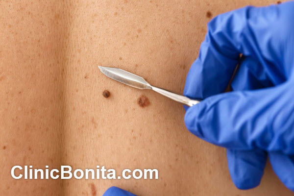 هزینه برداشتن خال و زگیل در اصفهان | کلینیک بنیتای اصفهان