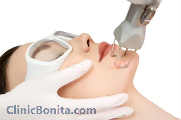 لیزر co۲ فرکشنال چیست؟