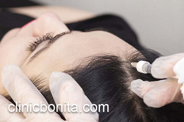 قیمت کاشت موی طبیعی در اصفهان چقدر است؟ | کلینیک بنیتای اصفهان