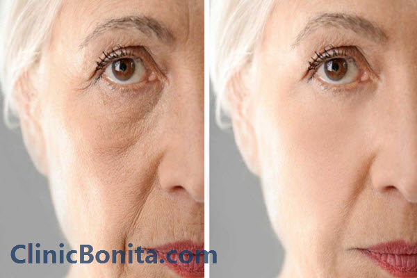 بهترین کلینیک لیزر co۲ فرکشنال در اصفهان