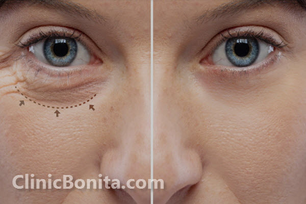 بلفاروپلاستی از طریق جراحی