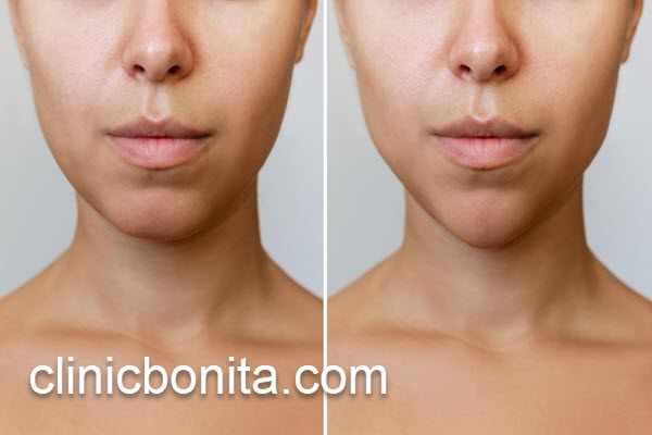 بهترین کلینیک بوکال فت در اصفهان | کلینیک بنیتای اصفهان