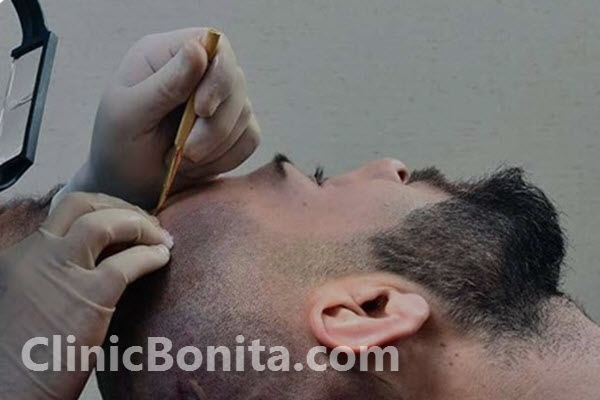 مزایای کاشت مو به روش FIT