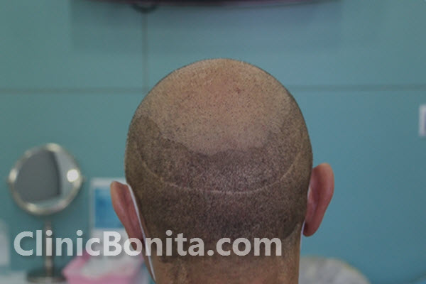 کاشت مو چیست؟ | کلینیک بنیتا