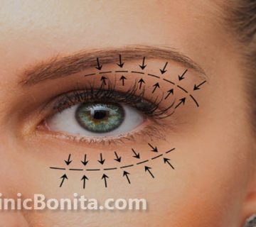 هزینه عمل بلفاروپلاستی در سال 1403 چقدر است؟