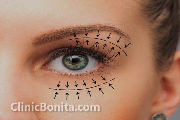 هزینه عمل بلفاروپلاستی در سال 1403 چقدر است؟