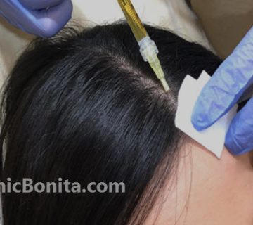 هزینه پی آر پی مو در سال 1403 ا کلینیک بنیتا