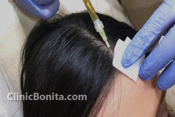 هزینه پی آر پی مو در سال 1403 ا کلینیک بنیتا