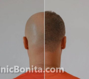 کاشت مو به روش FIT در اصفهان