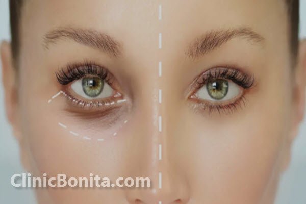 بلفاروپلاستی-چیست؟