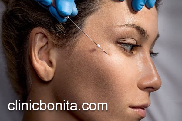 ماندگاری لیفت شقیقه با نخ | کلینیک بنیتای اصفهان